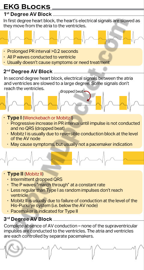 EKG