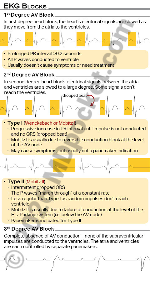 EKG_SNF